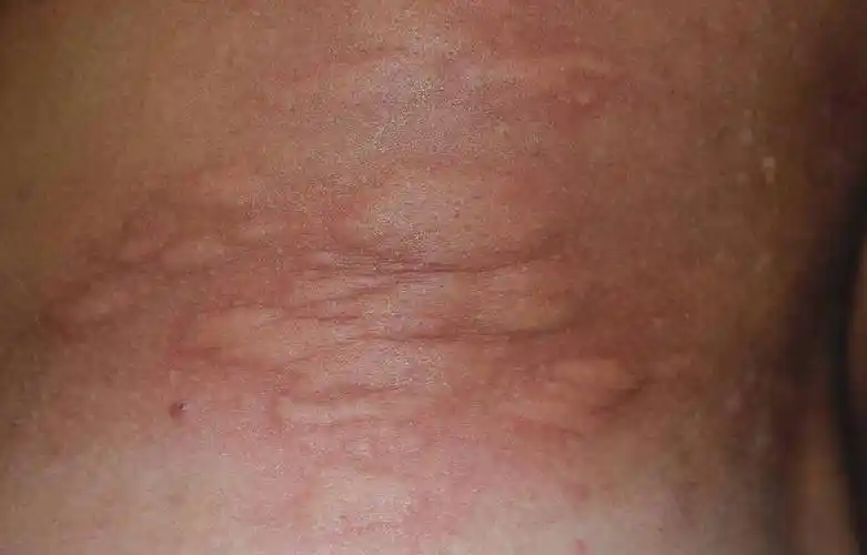 把艾滋病错当皮肤病,身体出现3种情况,警惕艾滋病找上_消息_疾病_症状