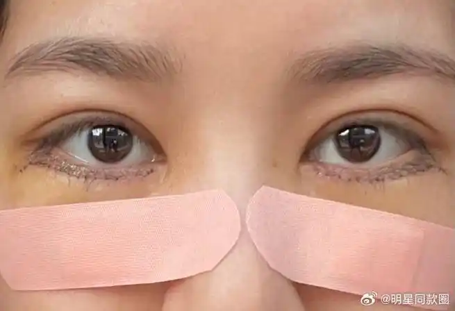 经过外切眼袋手术后的第三天,我的眼睛肿胀得特别厉害,冰敷了好几次才