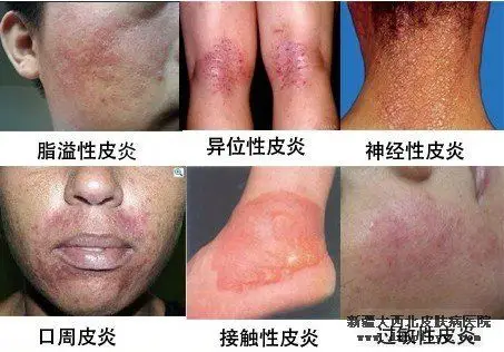 春风将吹来 你做好皮炎的预防工作了吗