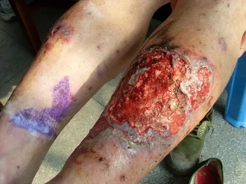 皮肤病恐怖的溃疡