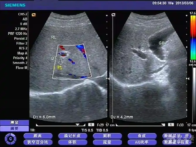 门静脉轻度扩张.