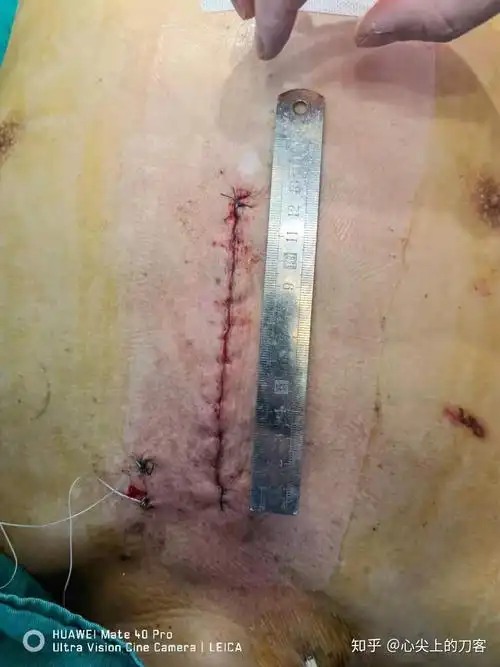 外有较多的微创心脏手术报道 ,包括右侧胸壁 (右腋 下 )小切口,胸骨旁