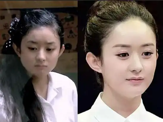 赵丽颖唯一承认过的整容项目:激光脱发际线!