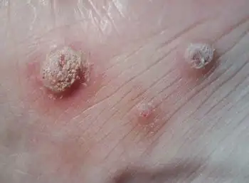 得了皮肤梅毒怎么办