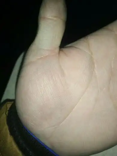 请问一下 这两天我突然发现我的双手 手掌发青 是怎么回事 这是什么