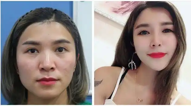 【惊艳】福州格莱美钟德成院长鼻部综合整形案例随访→术后1个月_第9