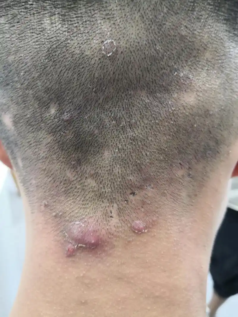 头皮毛囊炎症状.毛囊炎发病部位出现斑片状脱发.秃发性毛囊炎.