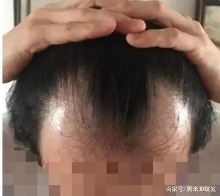 30岁男人遭遇"脱发危机",5个钟后枯木又逢春