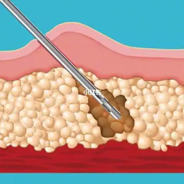 皮下脂肪 皮下脂肪很好理解,就是你能拉起来的那块肉,里面的脂肪_减肥