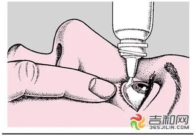 "红眼病"涂抹眼药膏易加重病情