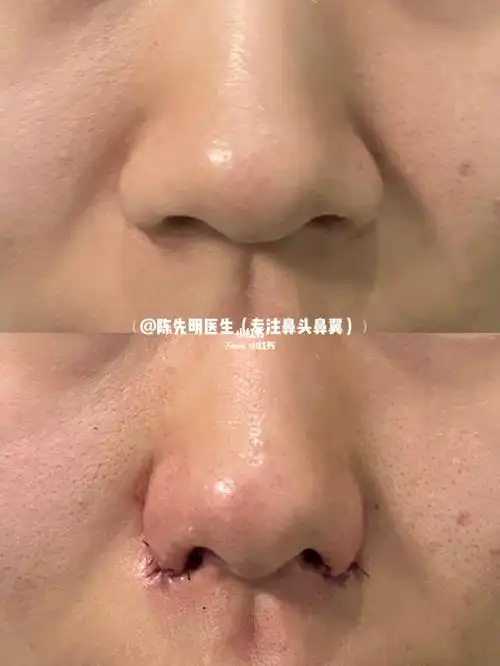 缩鼻翼术后即刻_缩鼻翼_鼻翼缩小_法令纹_外扩_美妆_医美整形