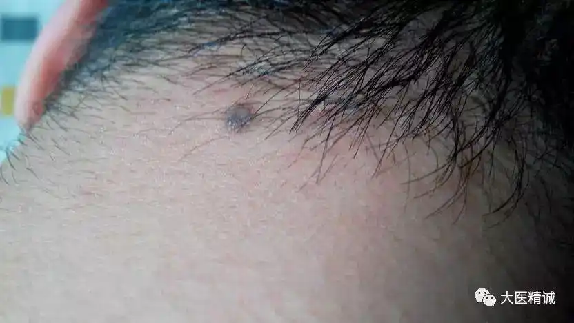 痣上长毛,是怎么回事?