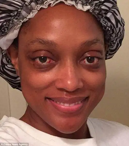 女子有双大眼睛看谁都像在瞪人,其实是患了罕见的病