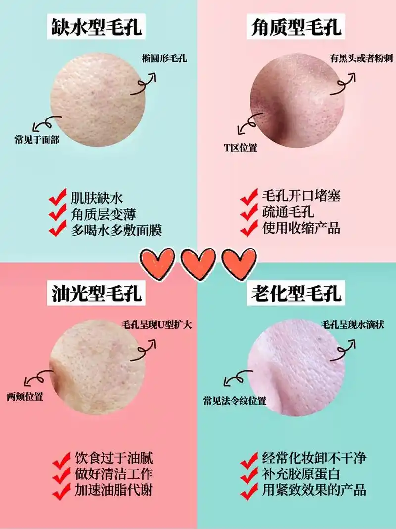 四种毛孔粗大类型,你是哪一种#护肤 #干货分享 #变美 #轻 - 抖音