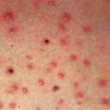 你把毛囊炎当成痘痘了吗