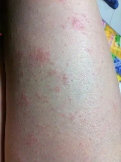 儿童手臂上起湿疹的现象图片_有来医生