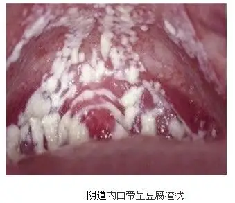 有些女性对于阴道过度的清洗,破坏了阴道的平衡,使其发生了霉菌性阴道