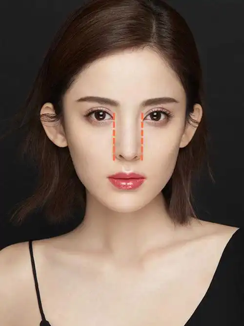 做了缩鼻头手术之后,山根和鼻翼宽度差不多,显得不太协调!