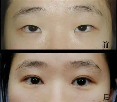 埋线双眼皮对比照片