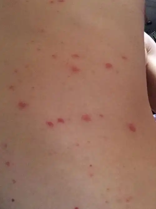 痒,红转发事实上一紧张全身就发痒与某些皮肤病大有联系,也就是说