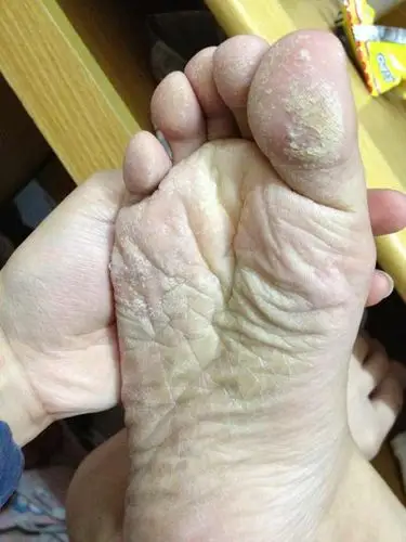 请问一下脚底这样子是什么情况,不痛不痒不臭