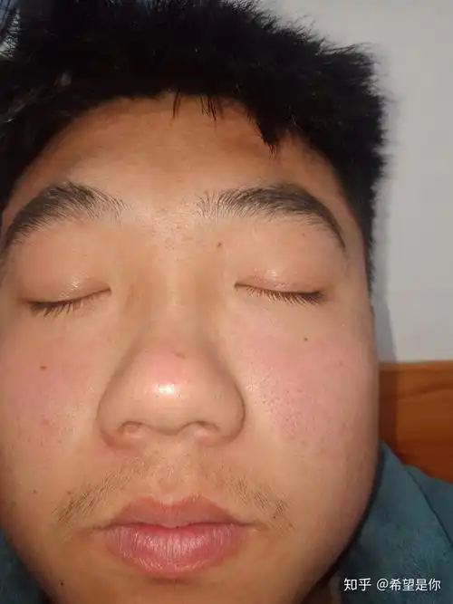 16岁男生毛孔粗大黑头粉刺