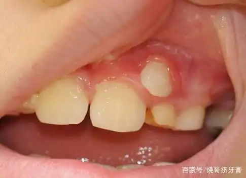 小孩的牙床上面多长了一个小牙齿是怎么回事