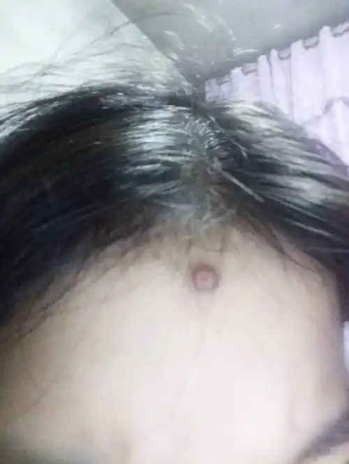 额头上先是长了一个痘,后来挤掉了以后变成了肉疙瘩,怎么办啊,很丑