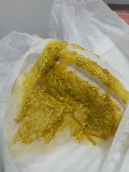 宝宝一天拉四五次这种奶瓣型大便,要怎么办啊?