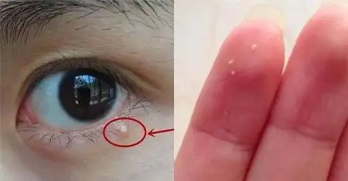 眼角的脂肪粒,用手挤太危险教你简单3招,轻松去除保证不留痕迹