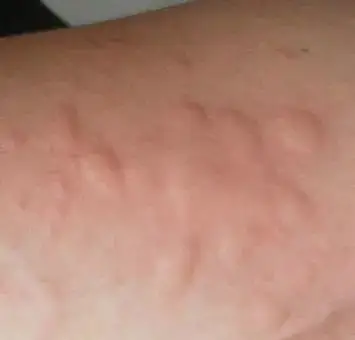 荨麻疹的11个过敏源荨麻疹过敏源大揭秘