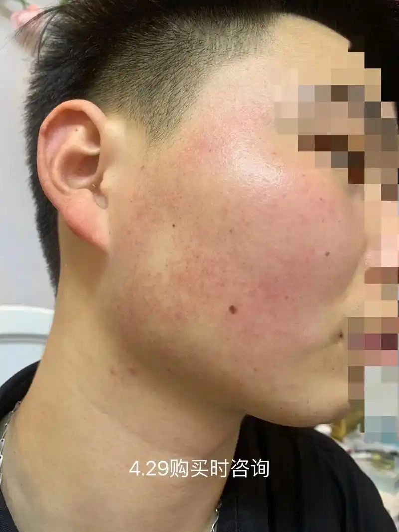 脸部敏感肌和鸡皮肤.