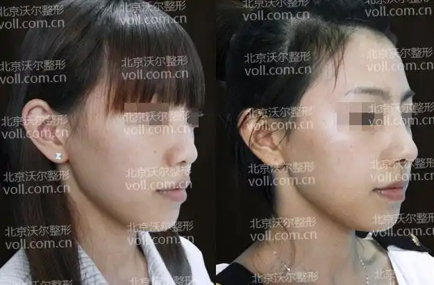 驼峰鼻矫正术前后对比照片案例四
