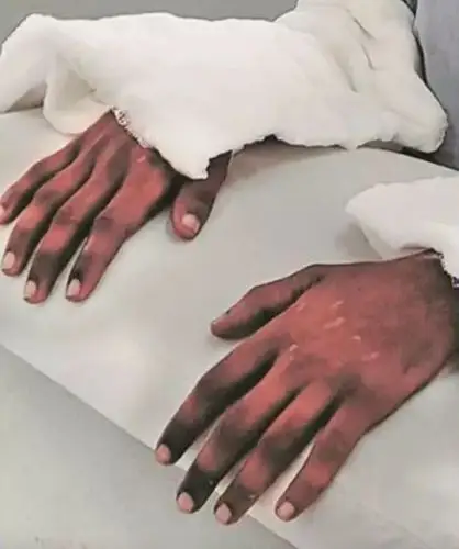 印度截肢女孩移植男子双手 两年后黑手成黄手变好看