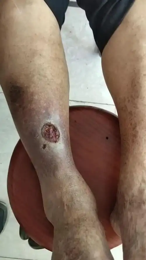 小腿部位溃烂多年,中药内服和外用药物相结合,可以治愈!