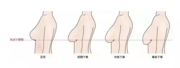 (乳下垂如何修复)断奶后胸部干瘪松弛下垂,针对这种情况该怎么改善?