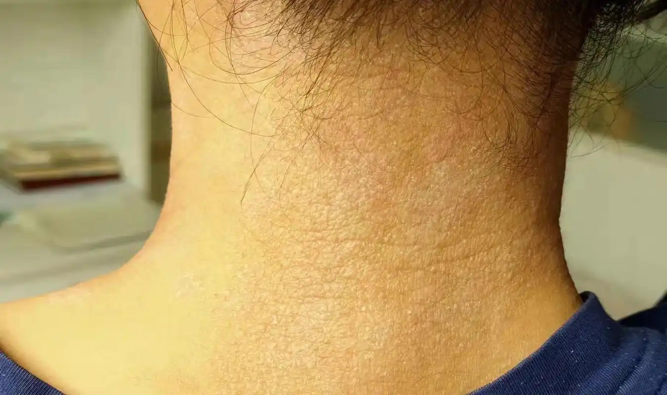 曾昕:没找到过敏源,你这个是干性湿疹,先用美肤安和夜膏,后面加上懒人