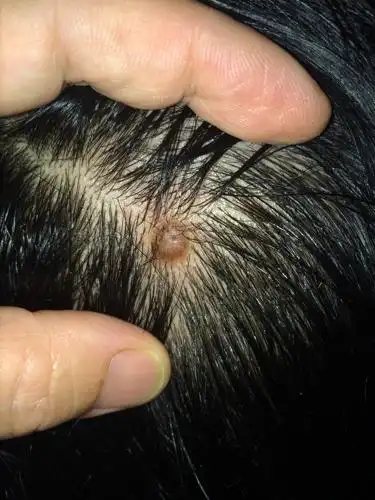 我目测不是疣,因为我以前得过 头部起个胞,摸了几个月的软膏也不见效