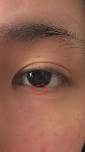 眼皮上长了一个不知道什么 谁知道怎么解决?