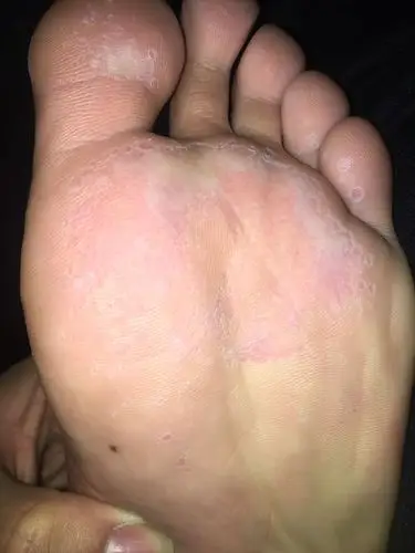 20 最近发现脚底成这样了,这是什么情况?本人汗脚,没有脚气.