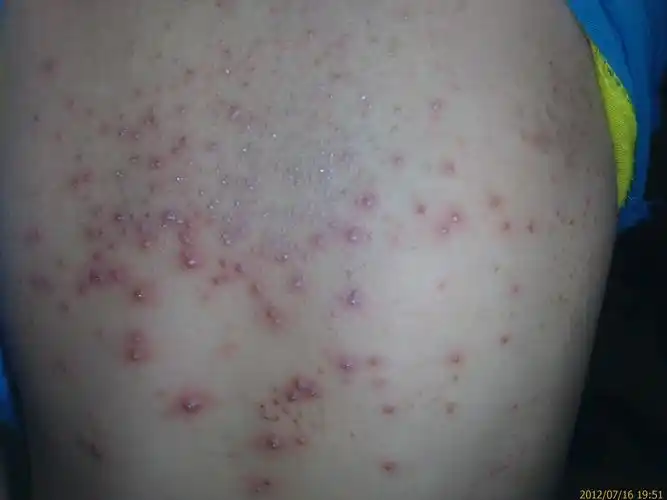 看图识病----马拉色菌毛囊炎(三天治愈)