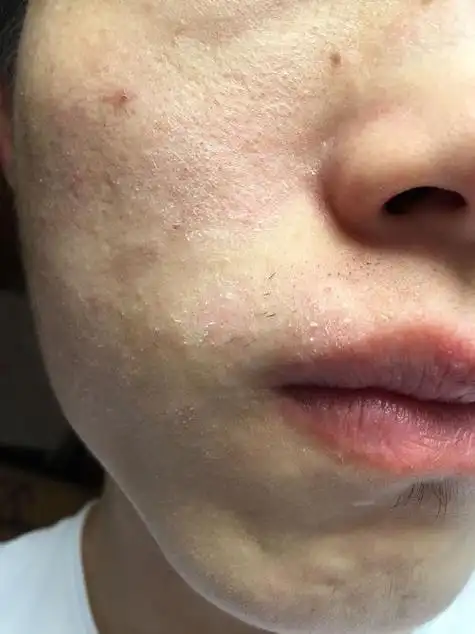 皮肤干燥脱屑像雪花怎么去除(皮肤干燥脱屑像雪花怎么办)