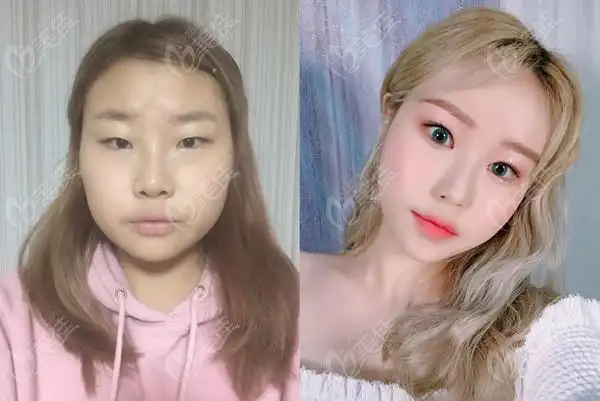 在韩国tj做全脸脂肪填充 眼综合前后对比