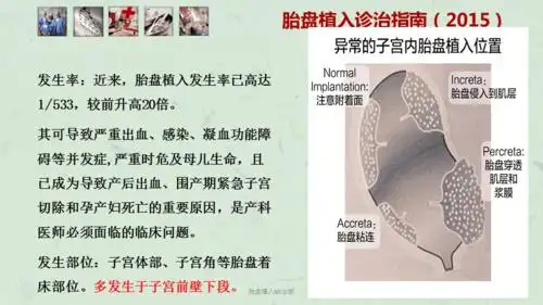 胎盘植入mr诊断课件