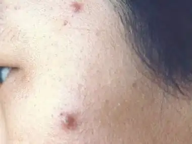 毛囊炎硬疙瘩图片大全