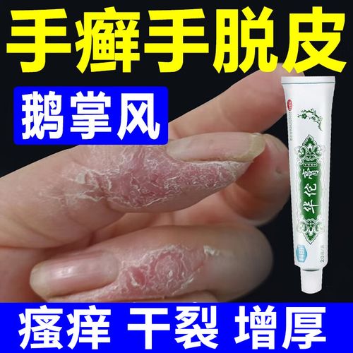 治鹅掌风药膏干裂脱皮手癣膏手掌粗糙变厚脱皮开裂真菌感染用药脱屑