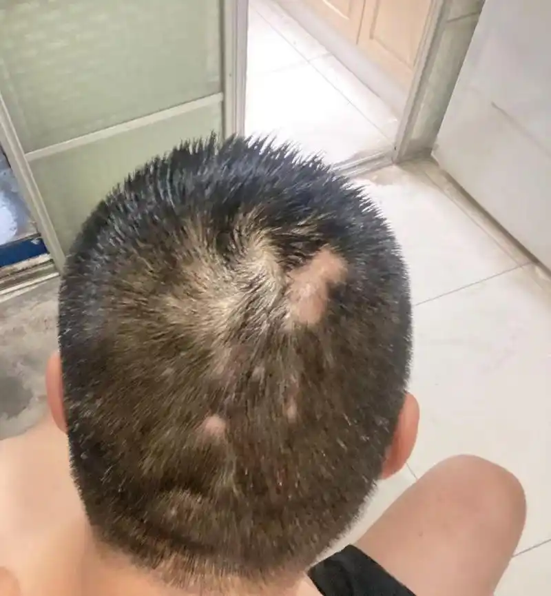 头上的脓包此起彼伏,这就是穿掘性毛囊炎.