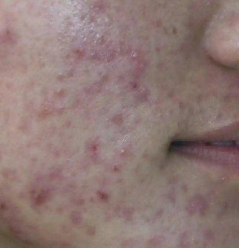 密集粉刺痤疮图片