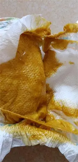 新生儿大便酸臭有奶瓣,是什么问题?