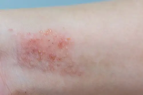 皮肤又红又痒究竟是哪里出了问题